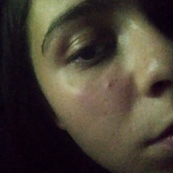 Claderm Kil Maskesini Yüzümü Yaktı.