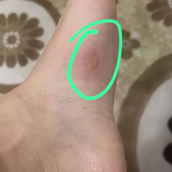 Desa Deri Parmak Arası Terlik Yara Yaptı