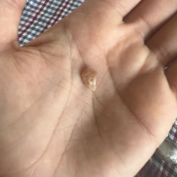 İnci Mantı Yerken Dişim Kırıldı