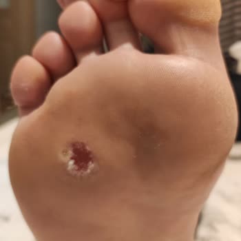 Yeni Yüzyıl Üniversitesi Gaziosmanpaşa Hastanesi Yanlış Nasır Tedavisi