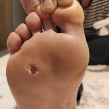 Yeni Yüzyıl Üniversitesi Gaziosmanpaşa Hastanesi Yanlış Nasır Tedavisi