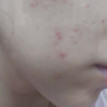 Nivea Ürünlerinde Sivilce Problemi