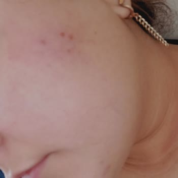 Sesu Tüy Sarartıcı Kötü