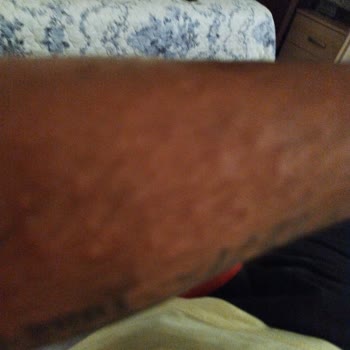 Eda Taşpınar Güneş Yağı Alerji