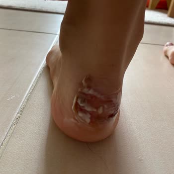 Nike'den Aldığım Ayakkabının Ayağımı Vurması