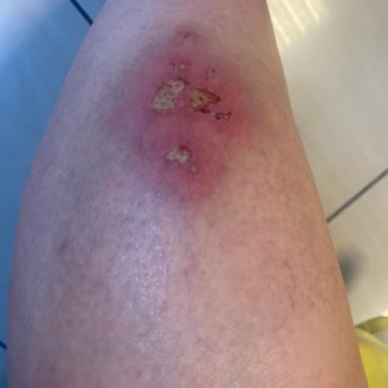 Vogue Hotel Supreme Bodrum Su Kaydırağından Bacağım Yaralandı