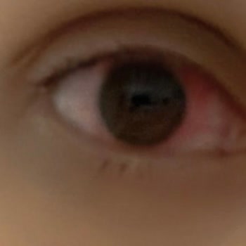 Labella Lens Gözlerimde Enfeksiyona Sebep Oldu