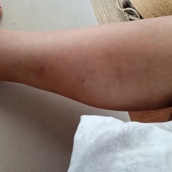 Climed Tedavi Merkezi Varis Tedavisi Mağduriyeti