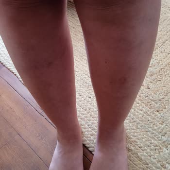 Climed Tedavi Merkezi Varis Tedavisi Mağduriyeti