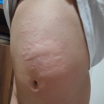 Dalin Bebek Şampuanı Alerji