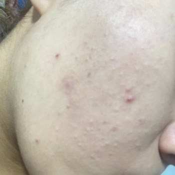 Bioderma Nemlendirici Yüzümde Kapalı Komedon Ve Sivilce Yaptı