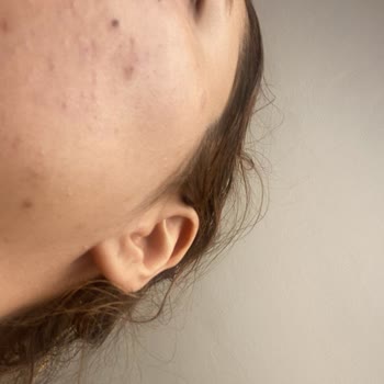 Bioderma Nemlendirici Yüzümde Kapalı Komedon Ve Sivilce Yaptı