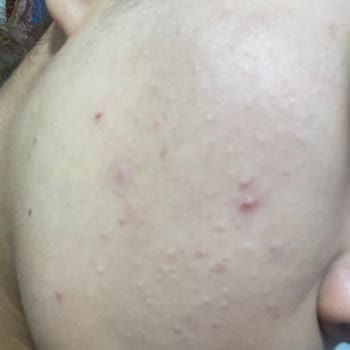 Bioderma Nemlendirici Yüzümde Kapalı Komedon Ve Sivilce Yaptı