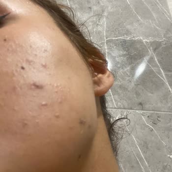 Bioderma Nemlendirici Yüzümde Kapalı Komedon Ve Sivilce Yaptı