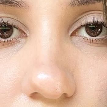 Kayseri Şehir Hastanesi Vanity Estetik Doktor Kötü Burun