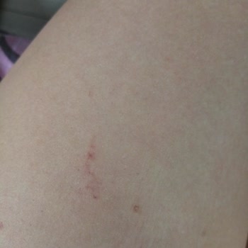 Estelia Vip Güzellik Merkezi İzmit Estelia Lazerde Yaktılar