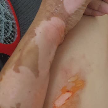 Karaca Züccaciye Karaca Red Düdüklü Tencere Seti Patladı