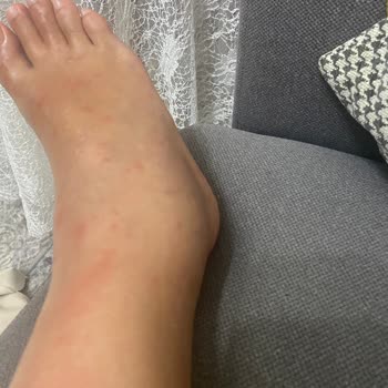 Assos Dove Hotel Odalarda Böcek Var