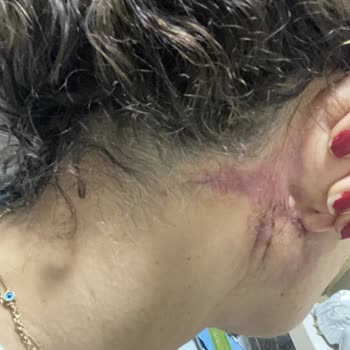 Op. Dr. Ömer Sağır Estetik Ve Plastik Cerrahi Muayenehanesi Mini Face Lift Ve Gıdı Sarkması