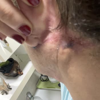 Op. Dr. Ömer Sağır Estetik Ve Plastik Cerrahi Muayenehanesi Mini Face Lift Ve Gıdı Sarkması