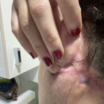 Op. Dr. Ömer Sağır Estetik Ve Plastik Cerrahi Muayenehanesi Mini Face Lift Ve Gıdı Sarkması