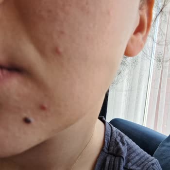 The Purest Solutions The Purest Sivilce