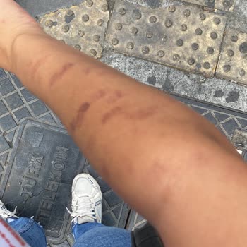 Çiğdem Koç Güzellik Çiğdem Koç Epilasyona Yanığı