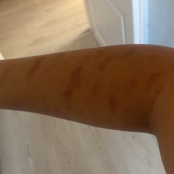 Çiğdem Koç Güzellik Çiğdem Koç Epilasyona Yanığı