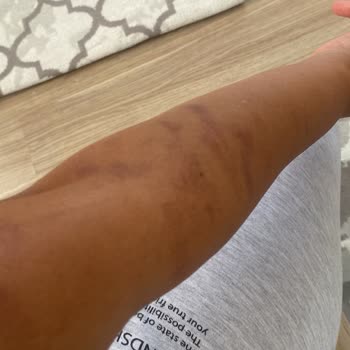 Çiğdem Koç Güzellik Çiğdem Koç Epilasyona Yanığı