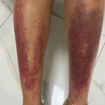 Eda Taşpınar Ürün Alerji Yaptı