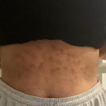 As Estetik (İstanbul) Epilasyonda Yanık Oluşturdular