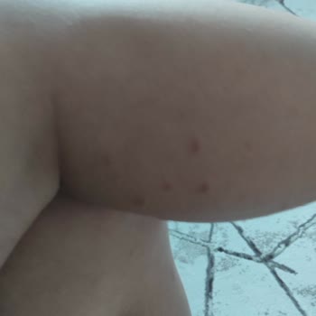 Zeynep Beauty Center Epilasyonda Vücudumun Her Yerinde Ciddi Yanıklar Oluştu