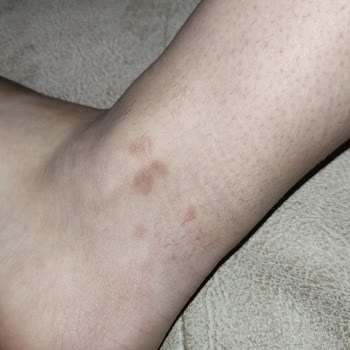 Zeynep Beauty Center Epilasyonda Vücudumun Her Yerinde Ciddi Yanıklar Oluştu