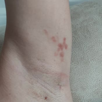 Zeynep Beauty Center Epilasyonda Vücudumun Her Yerinde Ciddi Yanıklar Oluştu