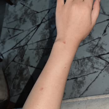 Zeynep Beauty Center Epilasyonda Vücudumun Her Yerinde Ciddi Yanıklar Oluştu