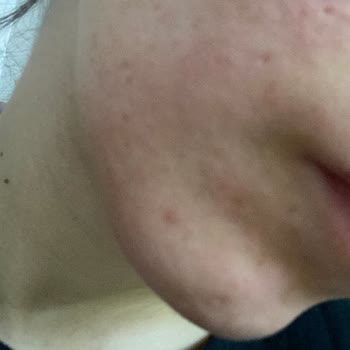 Estee Lauder Yüzümü Kurutup Kıpkırmızı Yaptı!