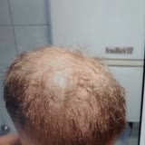 Clinichair (İzmir) ClinicHair'den 2 Saç Ekimi Başarısız