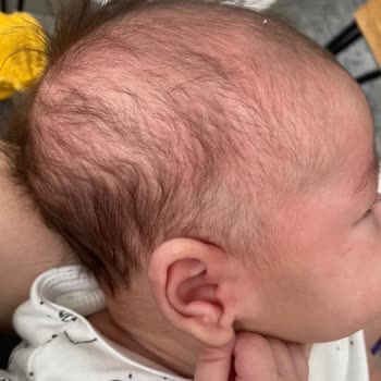 Uni Baby Bebeğime Alerji Yaptı!