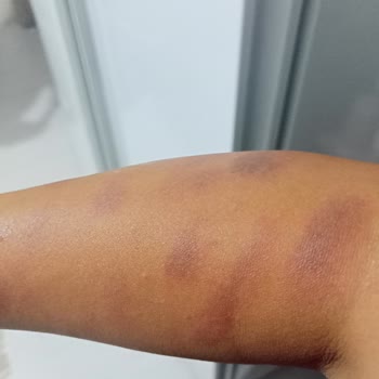 Paris Güzellik Salonu Iğdır Şubesinde Yaşadığım Yanıklar