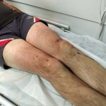 Grand Şahin's Gümüldür Resort Eşimin Üzerine Yürüyüp Burnunu Kırdılar