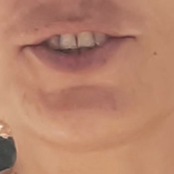 Dr. Well Güzelyalı Şubesi Epilasyon Yüz Yanığı