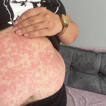 Özel Birlik Hastanesi Yanlış Tedavi Ve İlaç