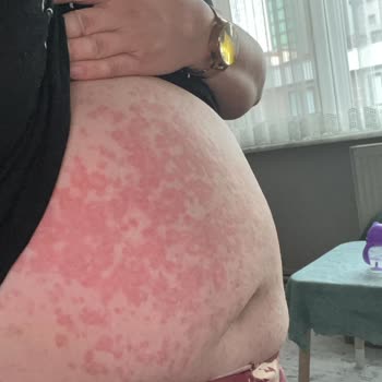 Özel Birlik Hastanesi Yanlış Tedavi Ve İlaç