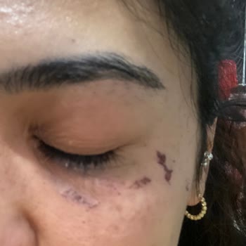 Esmyworld Güzellik Lazerde Yüzüm Ve Sırtım Yandı