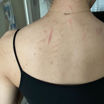 Esmyworld Güzellik Lazerde Yüzüm Ve Sırtım Yandı