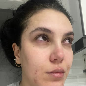 Maruderm Yıkama Jeli Göz Hasarı