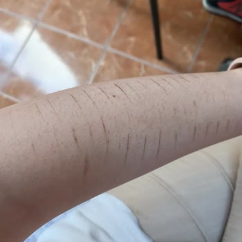 Bahar Acar Güzellik Merkezi Epilasyon Seansında Yaşadığım Olumsuz Deneyim