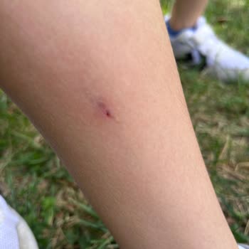 Bahçelievler Devlet Hastanesi Bir Şey Yok Denilen Yerden Çıkan Kıymık