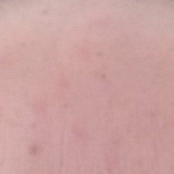 Rise & Shine Yüzümde Oluşan Kızarıklık