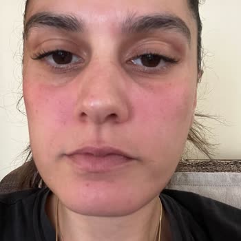 Yves Rocher Skin Care Caused Allergic Reactions